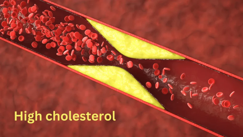 High cholesterol